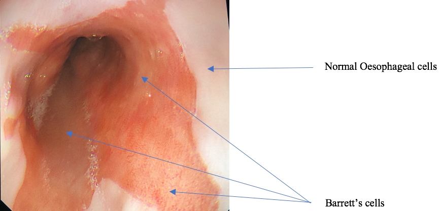 Surgical view of the presence of Barrett's Oesophagus