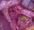 Surgical view of lower oesophagus and crura of diaphragm after dissection in a patient with a small hiatus hernia