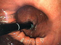 Endoscopic view of sliding hiatus hernia