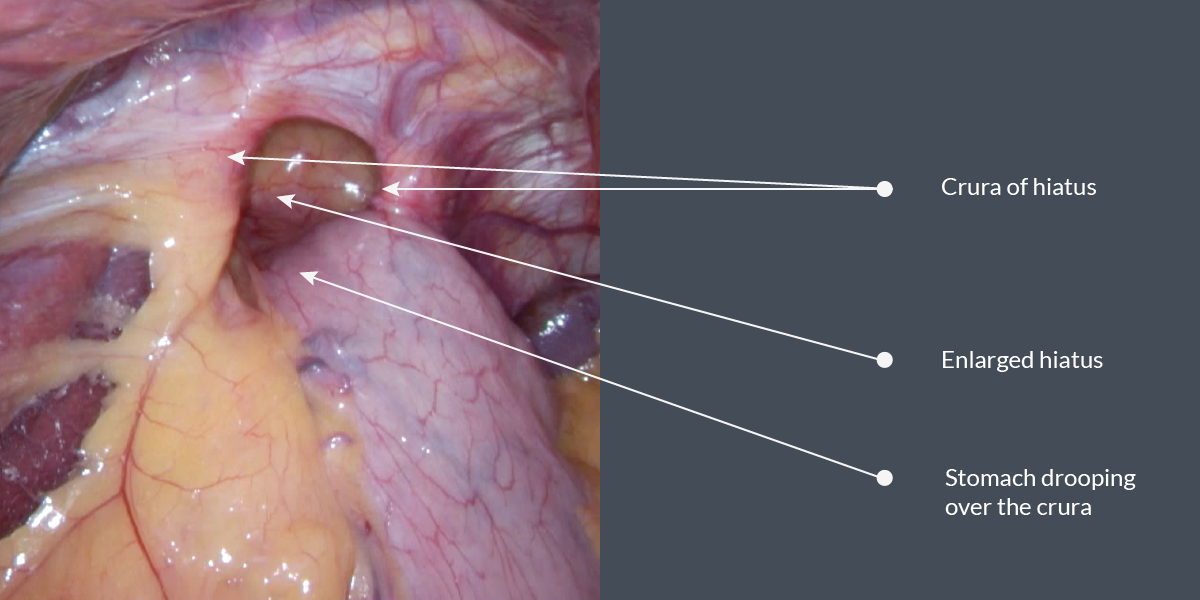 Surgical view of sliding hiatus hernia before dissection