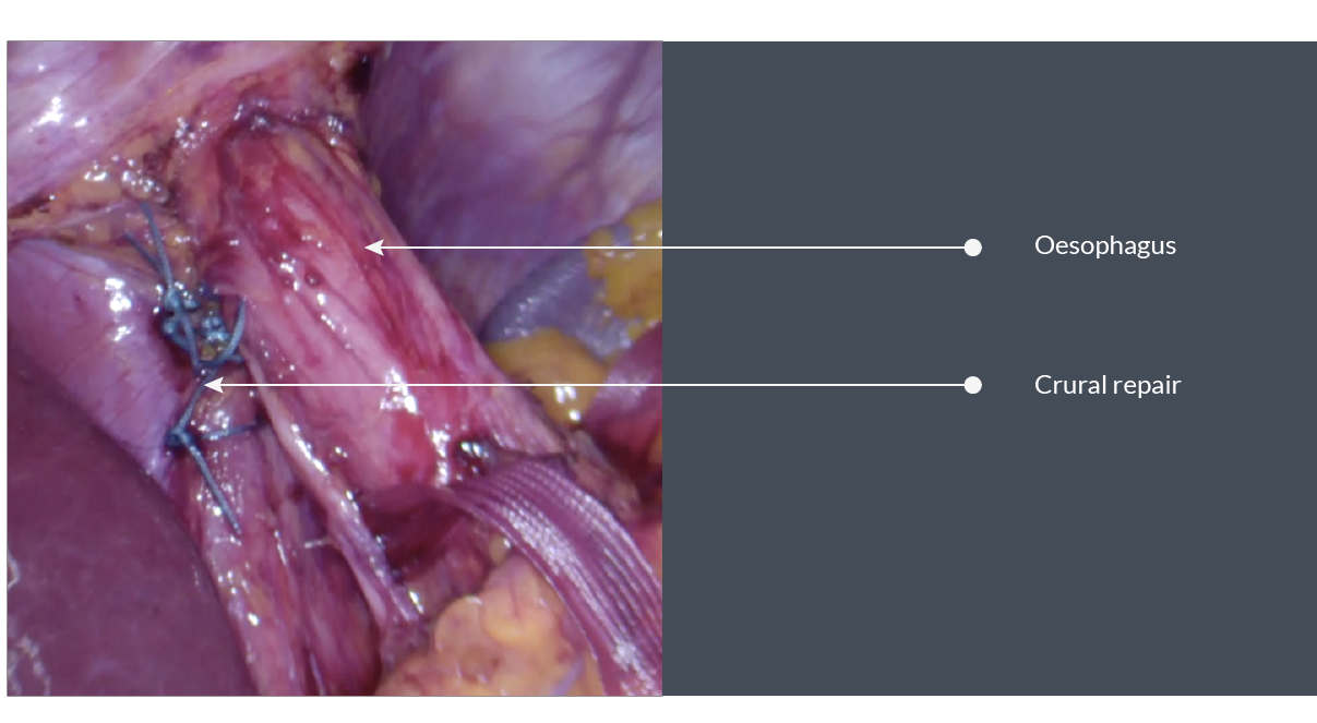 Surgical view of lower oesophagus and crura of diaphragm following crural repair