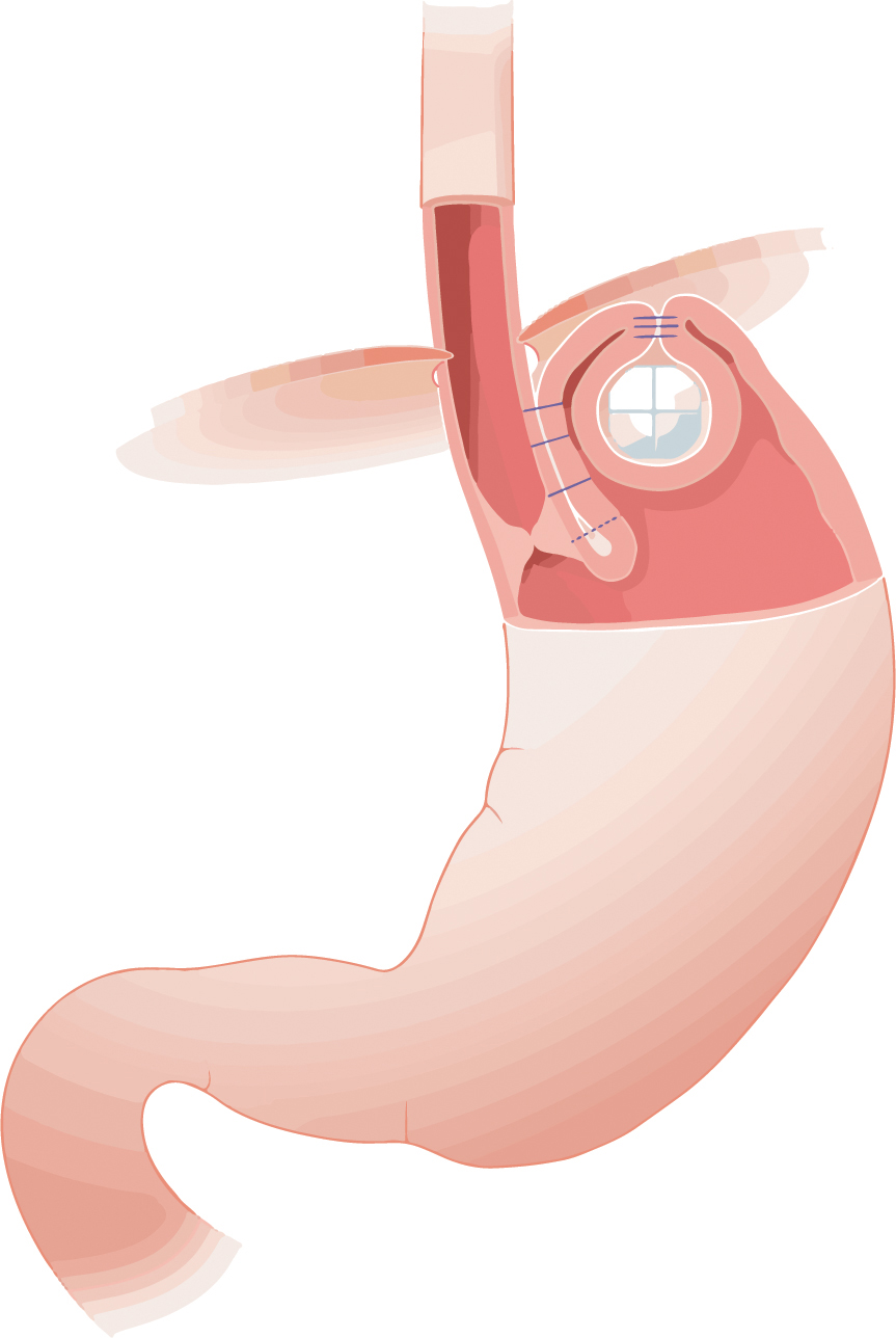 Diagram showing placement of RefluxStop device in the stomach