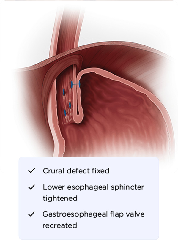 This image represents a cTIF procedure, highlighting the crural (hiatus hernia) repair, along with the stapling of the TIF procedure